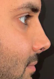 SP After Male Rhinoplasty