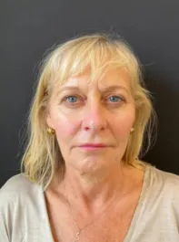 KY Before Face and Neck Lift with Fat Transfer