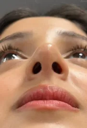 MA Septoplasty After pt.1