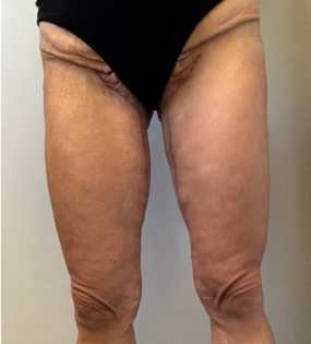 SSJ Thigh Lift After