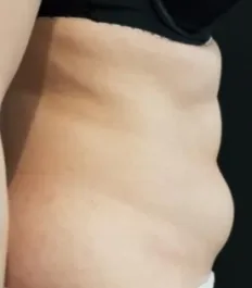 HS Abdomen Liposuction Before 2 Side
