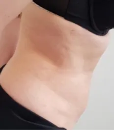 HS Abdomen Liposuction After 2 Side Bent