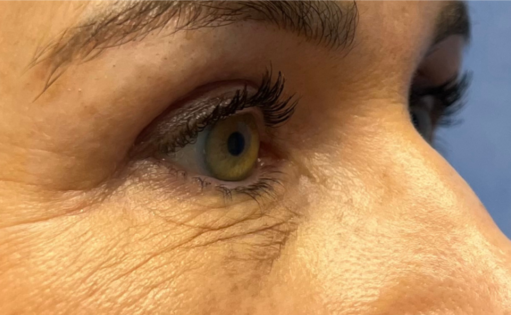 GG After Upper Blepharoplasty Three Quarters