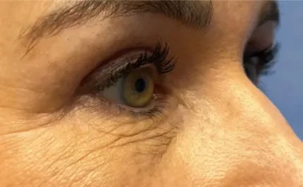GG After Upper Blepharoplasty Three Quarters