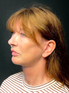 KY After Deep Plane Face and Neck Lift, Brow Lift, Lip Lift, Bleph & Fat Transfer