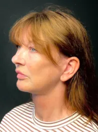 KY After Deep Plane Face and Neck Lift, Brow Lift, Lip Lift, Bleph & Fat Transfer