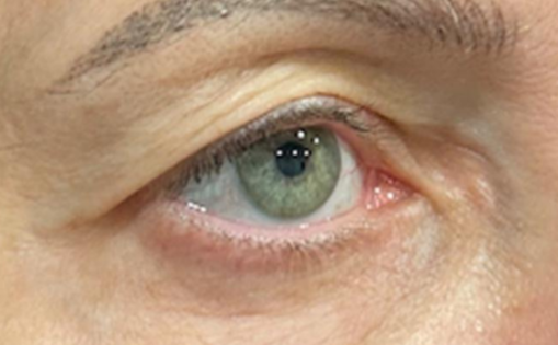 RR Before Upper Blepharoplasty