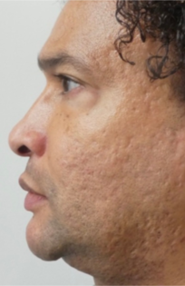 PT After Nose Tip Rhinoplasty