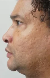 PT After Nose Tip Rhinoplasty