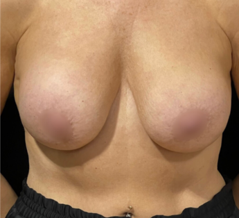 WS Before Mastopexy & Implant Removal