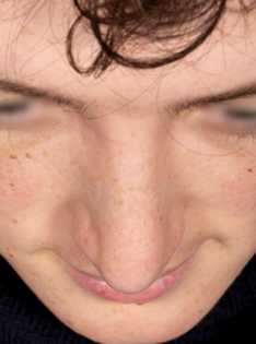 AN Rhinoplasty After
