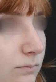 TJ After Rhinoplasty Three Quarter View