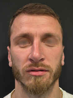 AN Rhinoplasty After