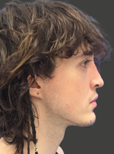 AN Rhinoplasty After