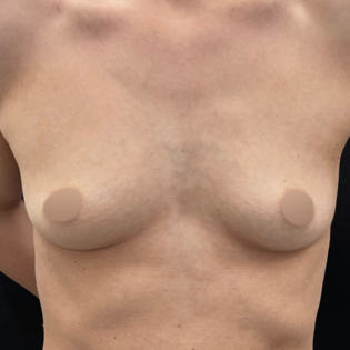 WS Breast Augmentation Before