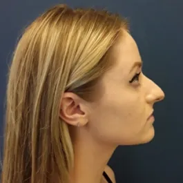 Unknown Before Rhinoplasty