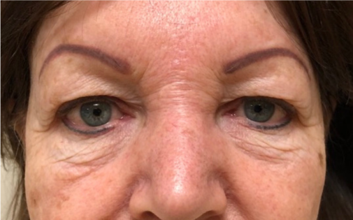 GG Before Upper and Lower Blepharoplasty