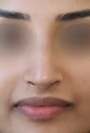 TJ After Rhinoplasty Front