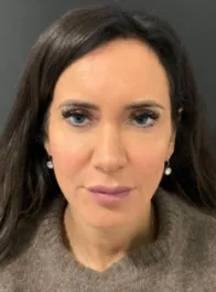 KY Before Deep Plane Face and Neck Lift, Brow Lift, Lip Lift, Bleph & Fat Transfer