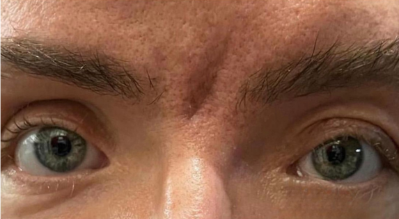 EH After Upper Blepharoplasty