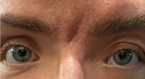 EH After Upper Blepharoplasty