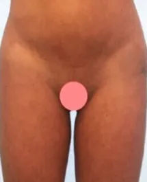 Unknown Inner Thigh Liposuction After 1 Front