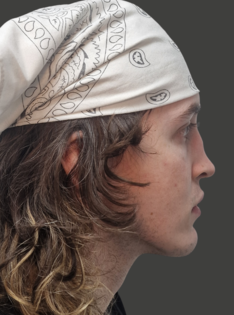 AN Rhinoplasty Before