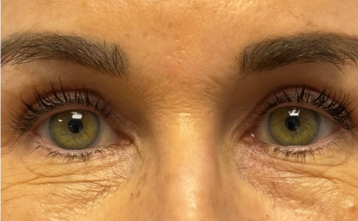 GG After Upper Blepharoplasty Front