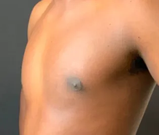 OT Male Chest Liposuction After 1 Three Quarter