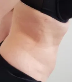 HS Abdomen Liposuction 2 After Side Bent