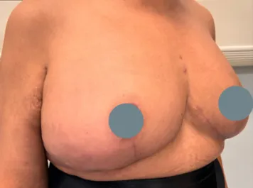 SSJ Mastopexy After