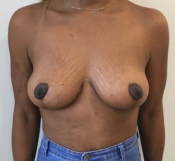 Unknown After Mastopexy