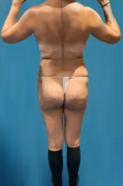 OT Flanks Liposuction Before 2 Back
