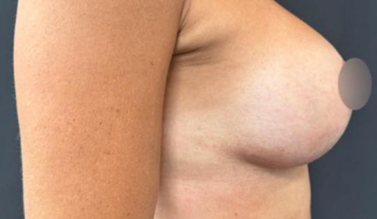 WVN After Mastopexy & Implant Exchange Side
