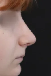 TJ After Rhinoplasty Profile