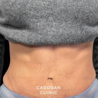 Cadogan Clinic PT Abdo After