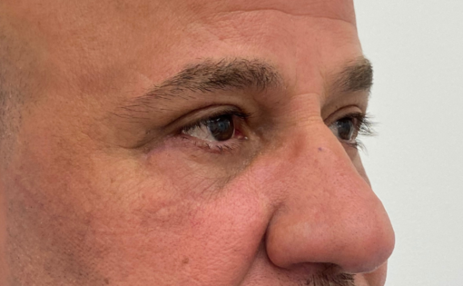EH After Male Lower Blepharoplasty