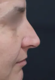 TJ Before Septorhinoplasty Profile