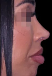 MA Rhinoplasty After Side