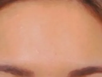 NAH White Scar Treatment Forehead After