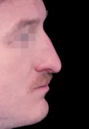 MA Male Rhinoplasty Before Side