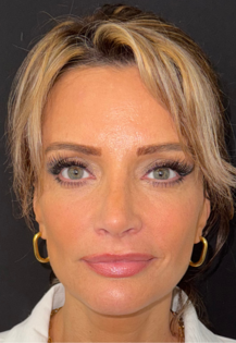 SP After Septorhinoplasty Front