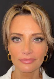 SP After Septorhinoplasty Front