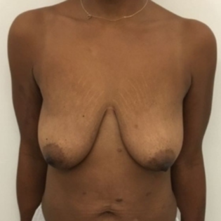 Breast Lift Unknown Before