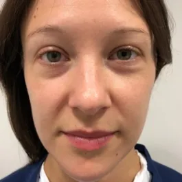Unknown Before Rhinoplasty