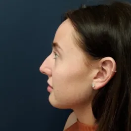 Unknown Before Rhinoplasty
