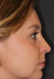 Unknown After Rhinoplasty