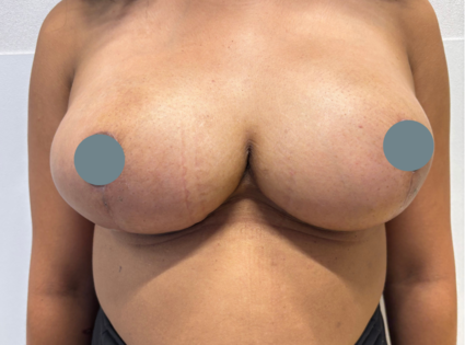 SSJ Breast Reduction After