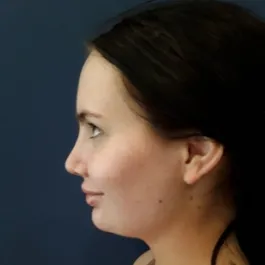 Unknown Before Rhinoplasty