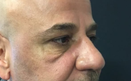 EH Before Male Lower Blepharoplasty